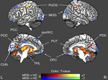 주요우울장애 환자에서 정상대조군과의 대뇌 회백질 부피비교결과.