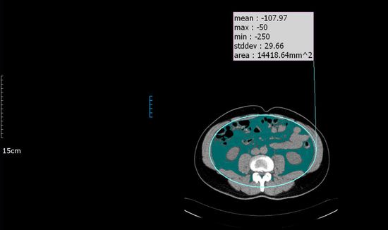 내장비만 환자의 복부 CT: 초록색으로 표시된 부분이 내장지방. 이미지 제공: 서울대병원