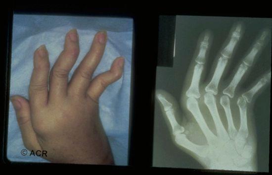 루푸스로 인해 손가락 관절이 변형된 사진.