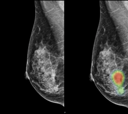 우측 유방에 침습성 소엽 암종이 있는 49세 여성의 유방 촬영 모습이다. 이미지 제공: 루닛