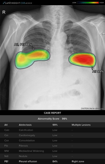 GE와 루닛의 합작으로 탄생한 인공지능 기반 엑스레이 분석 솔루션 ‘흉부 케어 스위트(Thoracic Care Suite)’에서 공개한 분석 리포트 샘플 모습