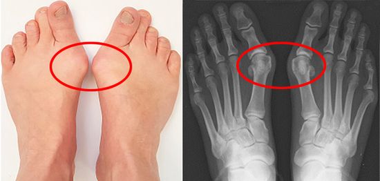 엄지발가락이 과도하게 휘면서 관절이 튀어 나온 무지외반증 환자의 발과 X-ray 영상. 사진 제공: 서울대병원