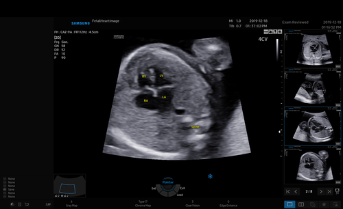 하트어시스트 실행 시 태아 심장 초음파 화면에서 자동으로 심장을 인식하고 주석을 표시한 화면. 이미지 제공: 삼성메디슨