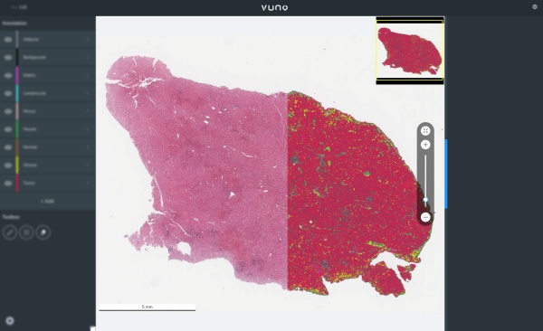 뷰노 병리 분석 인공지능(AI) 플랫폼 ‘뷰노메드 패스랩’에서 간암 병리 슬라이드를 정량화한 모습