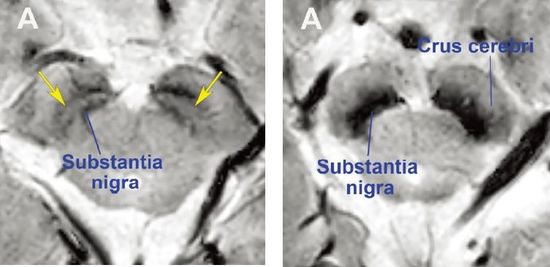 정상 모양의 흑질(사진 왼쪽), 파킨슨병 환자의 흑질(사진 오른쪽) MRI 영상.