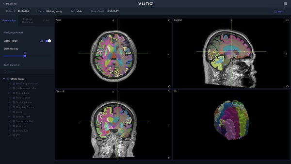뷰노메드 딥브레인은 뇌 MRI를 기반으로 뇌 영역을 100여개 이상으로 분할(parcellation)하고 주요 뇌 영역의 위축정도 정보를 제공한다.