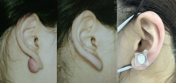 사진 왼쪽부터 ▲켈로이드 수술 전 ▲켈로이드 수술 후 ▲실리콘 겔 시트·자석 병합치료 모습