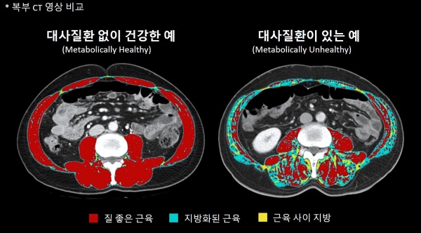 대사질환 없이 건강한 사람과 그렇지 못한 사람의 복부 CT 영상 비교