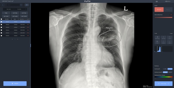 AI 기반 흉부 X-ray 영상 판독 보조 솔루션 ‘뷰노메드 체스트 엑스레이’