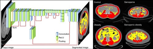 CT영상에서 인공지능을 이용해 몸의 체성분을 분류하는 과정(왼쪽),체성분에 따라 정상, 비만, 근감소증, 근감소성 비만의 대표적인 CT영상을 근육과 내장지방으로 구분한 이미지(오른쪽)