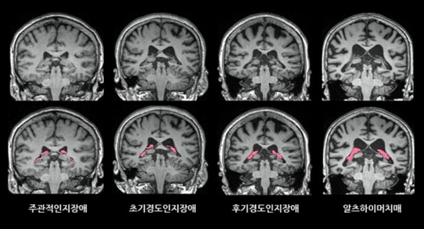 뇌 MRI 영상에서 맥락얼기의 부피(빨간색)가 치매가 진행함에 따라 더 증가한 것을 확인할 수 있다.