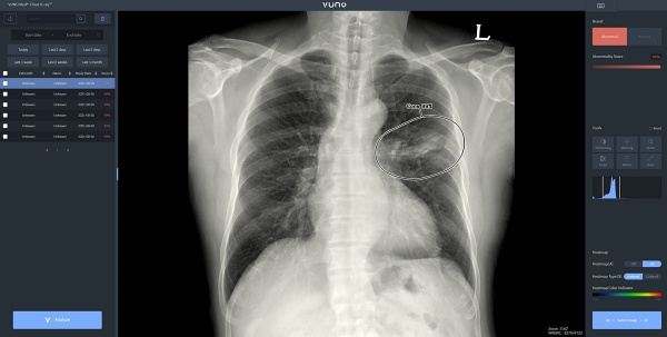 AI 기반 흉부 엑스레이 영상 판독 보조 솔루션 ‘뷰노메드 체스트 엑스레이’(VUNO Med-Chest X-ray)