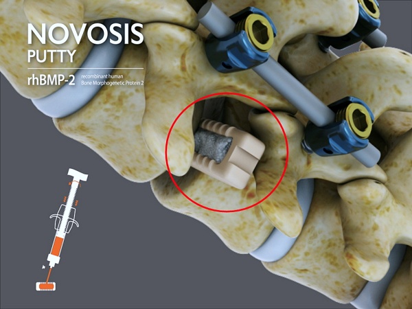 척추 유합술에 골대체제 ‘노보시스 퍼티’를 적용한 모습