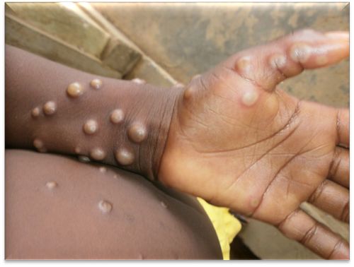 사진 출처: 나이지리아 질병통제센터(Nigeria Centre for Disease Control)