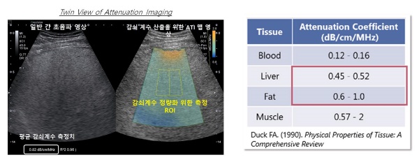 캐논메디칼 “초음파 ATI 기술, 지방간 정량검사로 조기진단 지원”