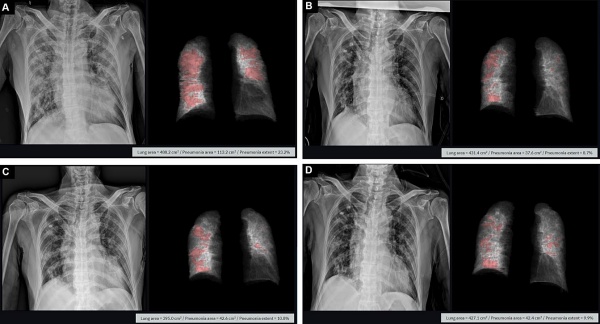 의학분야 국제학술지 'PLOS ONE'에 게재된 코로나19 확진자 X-ray 영상 및 티셉을 활용한 폐렴 분석 이미지