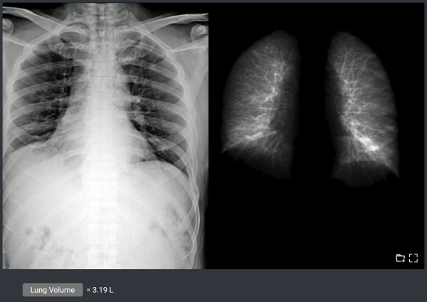TiSepX Lung Volumetry를 활용해 폐 용적을 분석한 화면