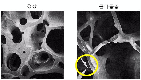 정상인과 골다공증 환자의 뼈 단면 비교 사진