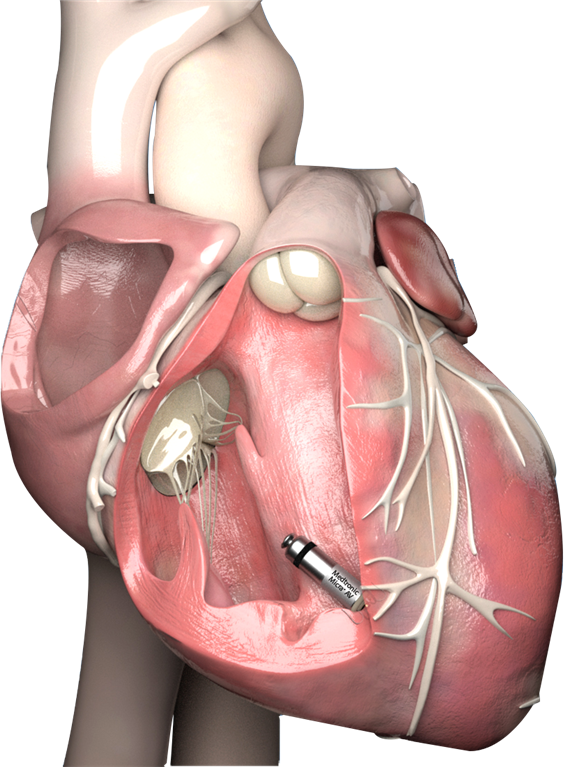 심장내 삽입된 무전극선 심박동기 예시 이미지. 이미지 제공: 서울시보라매병원 